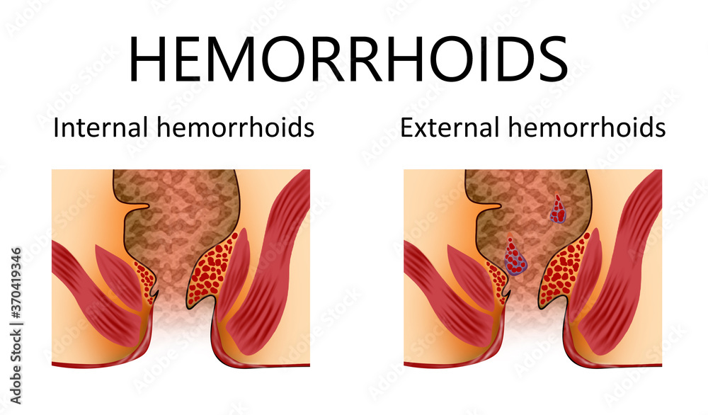 Laden Sie Hemorrhoid types. Unhealthy lower rectum with inflamed vascular structures, illustration Stock-Illustration herunter und finden Sie ähnliche Illustrationen auf Adobe Stock.