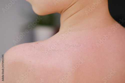 back of a child with sunburns and peeling dead skin of a 6-7 year old boy with sunscreen, body hygiene concept, sunburn