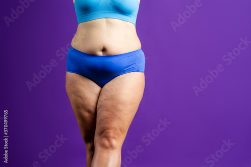 Obraz na plátne Tummy tuck, flabby skin on a fat belly, plastic surgery concept