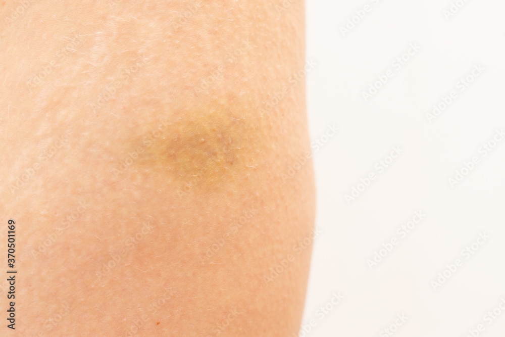 The result of domestic violence. Bruise on the leg The result of domestic violence. Bruise on the leg