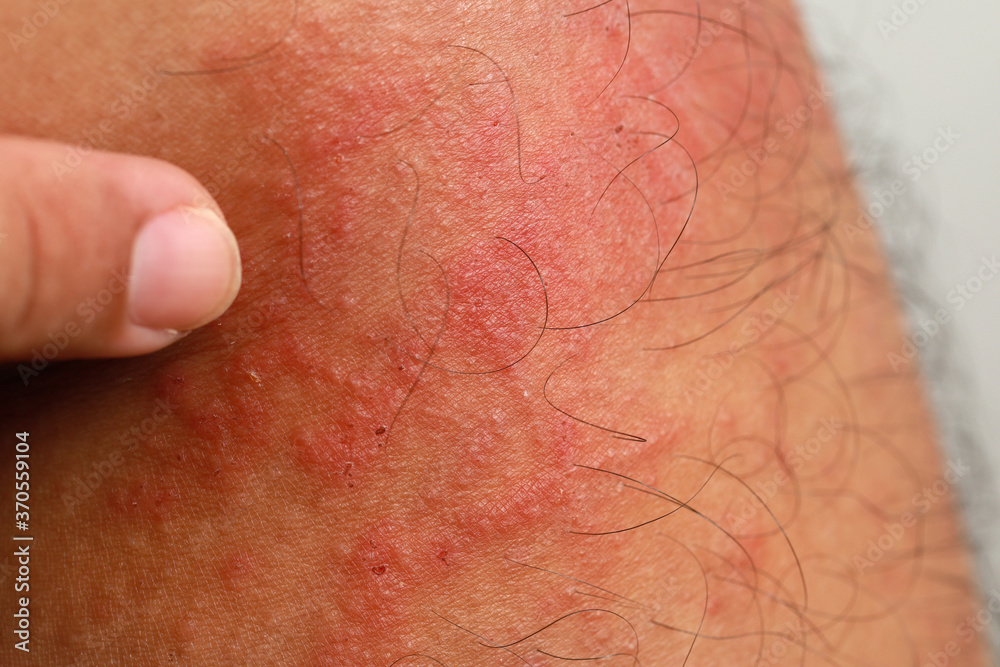 Close up dermatitis on skin, ill allergic rash dermatitis eczema skin of patient , atopic dermatitis symptom skin detail texture , Fungus of skin ,The concept dermatology.