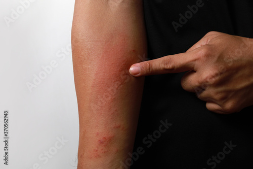 Close up dermatitis on the skin, ill allergic rash dermatitis eczema skin of a patient, atopic dermatitis symptom skin detail texture. Fungus of human skin. photo