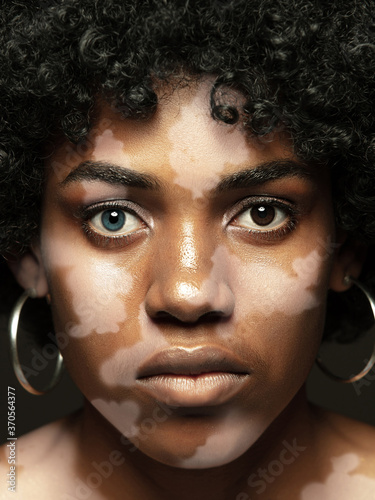 Portrait of african-american woman with vitiligo skin. Special skin with depigmentation because of melanin losing. Concept of skincare and healthcare, inclusion and diversity, fashion and beauty. photo