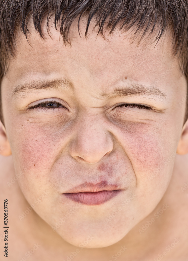 Naklejka premium Young Boy With A Herpes On His Lip