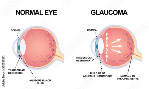 Eye structure. Anatomy of an eye defect, Glaucoma photo