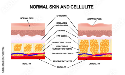 Normal skin and cellulite. Vector illustration with symbols