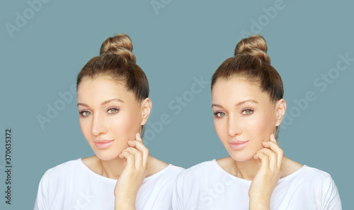 Rhinoplasty.Before and after 