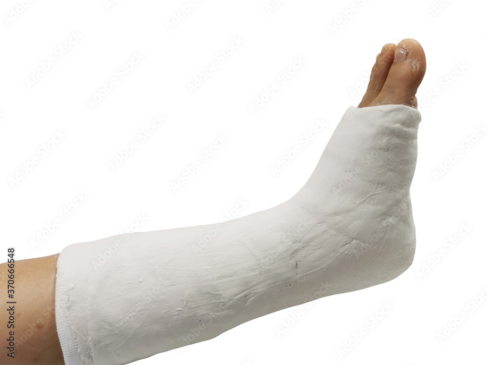 Leg bandaged in a plaster cast for fracture of the leg and ankle joint, isolate on white background. Patient with broken leg from the accident and splints for treatment. Leg bandaged in a plaster cast for fracture of the leg and ankle joint, isolate on white background. Patient with broken leg from the accident and splints for treatment.
