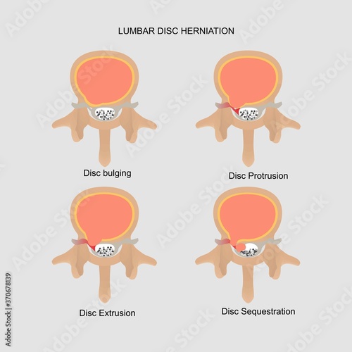 Vector illustration of lumbar disc herniation