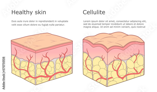 Cellulite formation illustration