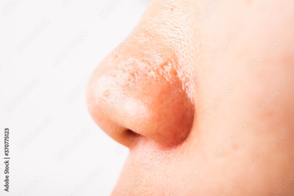 Fototapeta premium Closeup Asian young woman large pores have freckles cheek oily, acne pimple on nose, studio shot isolated on white background, Healthcare beauty skin face problem concept