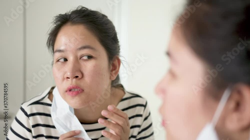 Young adult asian woman worry unhappy with skin acne or pimples from wearing face mask showing swollen, spot, scar, skin allergy on chin and cheek in mirror in maskne covid-19 social distance concept. photo