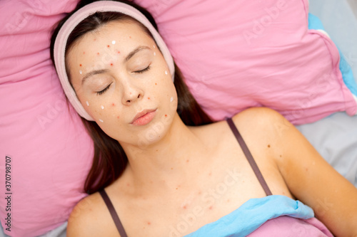 Fotografie Portrait of young woman with chickenpox varicella virus, with face sadness in be