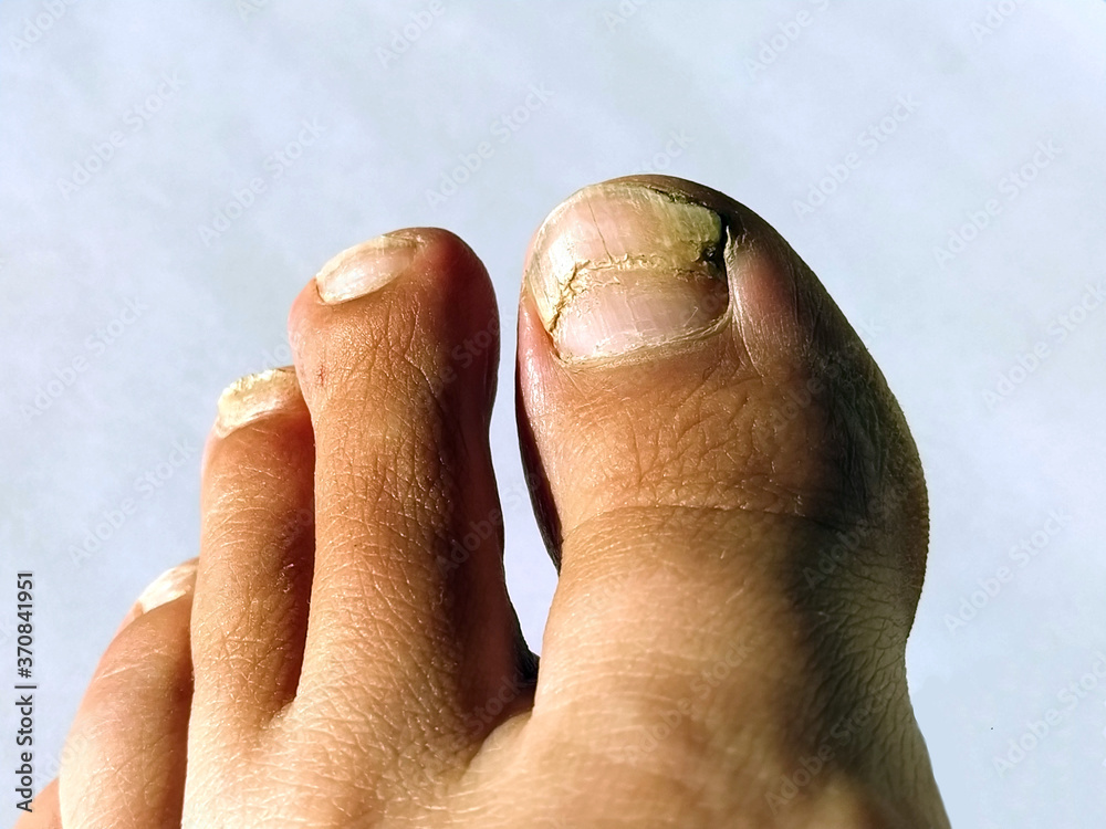 A toenail fungus at the peak of the infection. Painful toe contagious with onychomycosis. Active