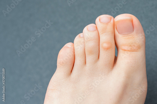 A young woman has hard corns and calluses on her toes from wearing shoes that uncomfortable and don't fit properly. Female foot. Close up view.