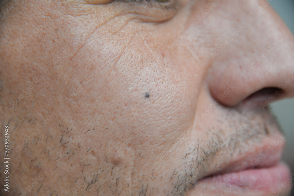 Skin diseases irritation, itching, cracked wounds lead to painful sensations. The skin may grow papillomas, warts, moles, white and dark spots will appear. Skin diseases irritation, itching, cracked wounds lead to painful sensations. The skin may grow papillomas, warts, moles, white and dark spots will appear.