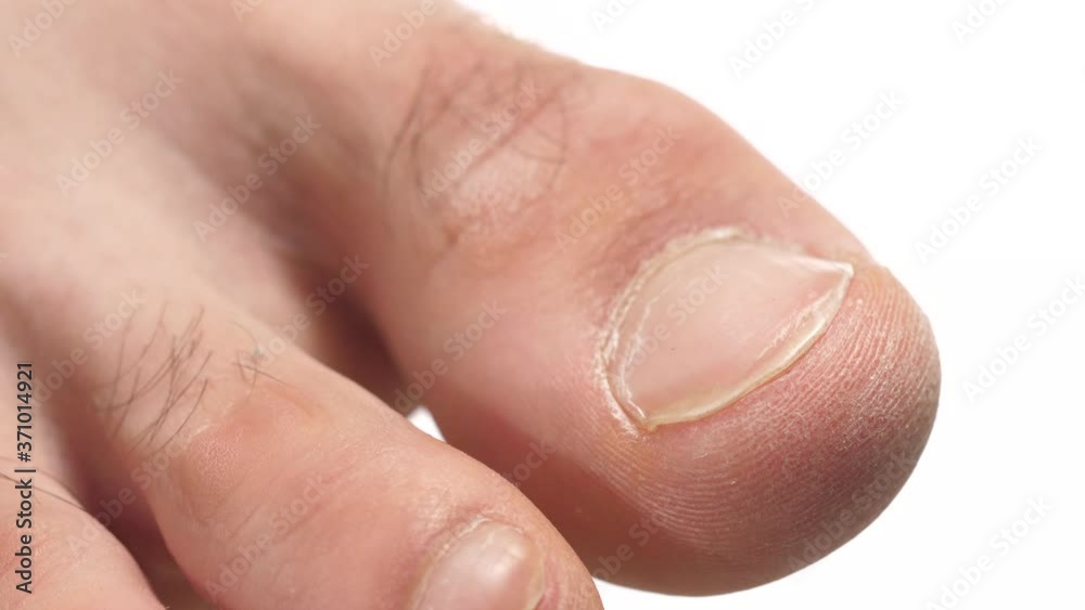 Closeup on the toe of a foot of a young man. Human body part over a white screen background. Closeup on the toe of a foot of a young man. Human body part over a white screen background.