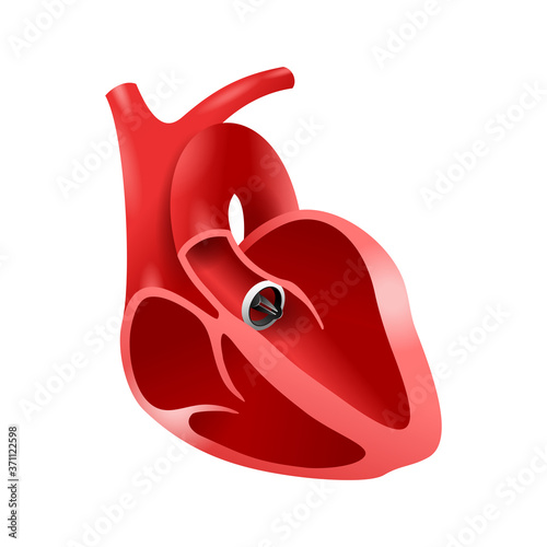 Artificial heart valve (aortic bileaflet) implanted into heart to replace a disfunctional native valve
