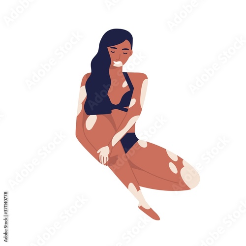 Young self acceptance woman with vitiligo relaxing in bikini. Body positive, brunette girl with skin depigmentation or pigmentation. Flat vector cartoon illustration isolated on white background