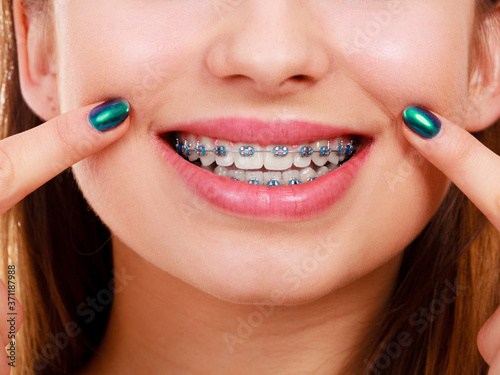 Woman showing her teeth with braces photo