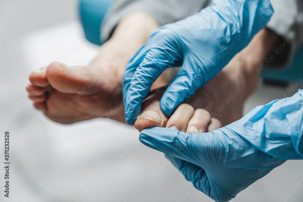Podiatrist treating feet during procedure - obrazy, fototapety, plakaty 