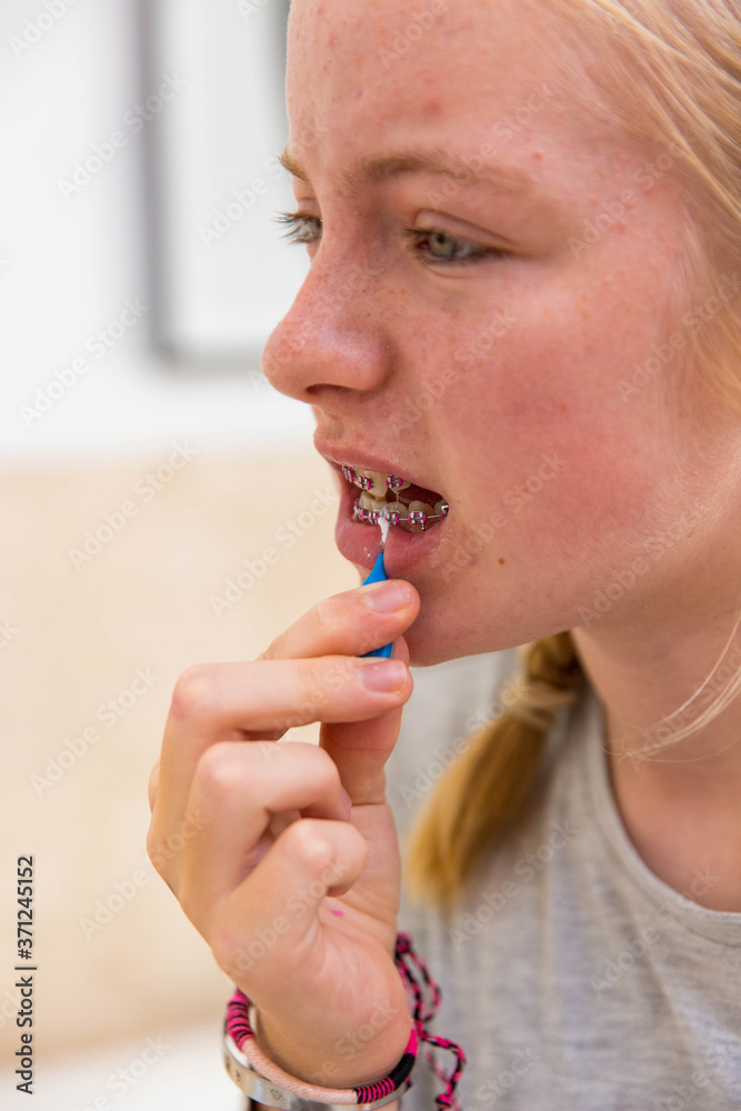 Cleaning teeth and braces Cleaning teeth and braces
