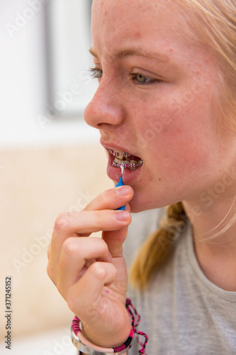 Cleaning teeth and braces photo