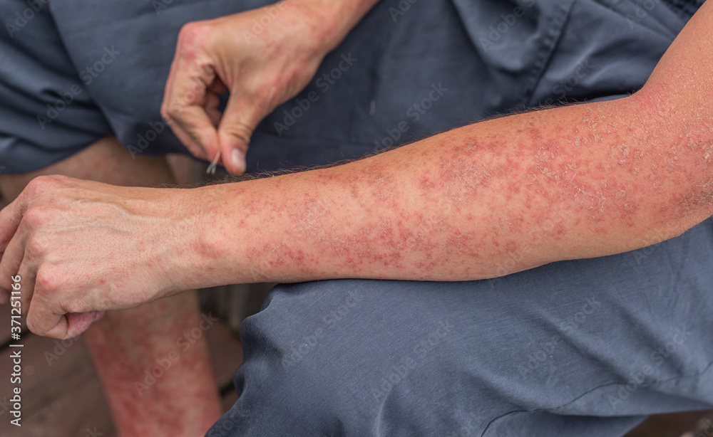 Dyshidrotic autoimmune eczema of patient. Concept of health care Stock