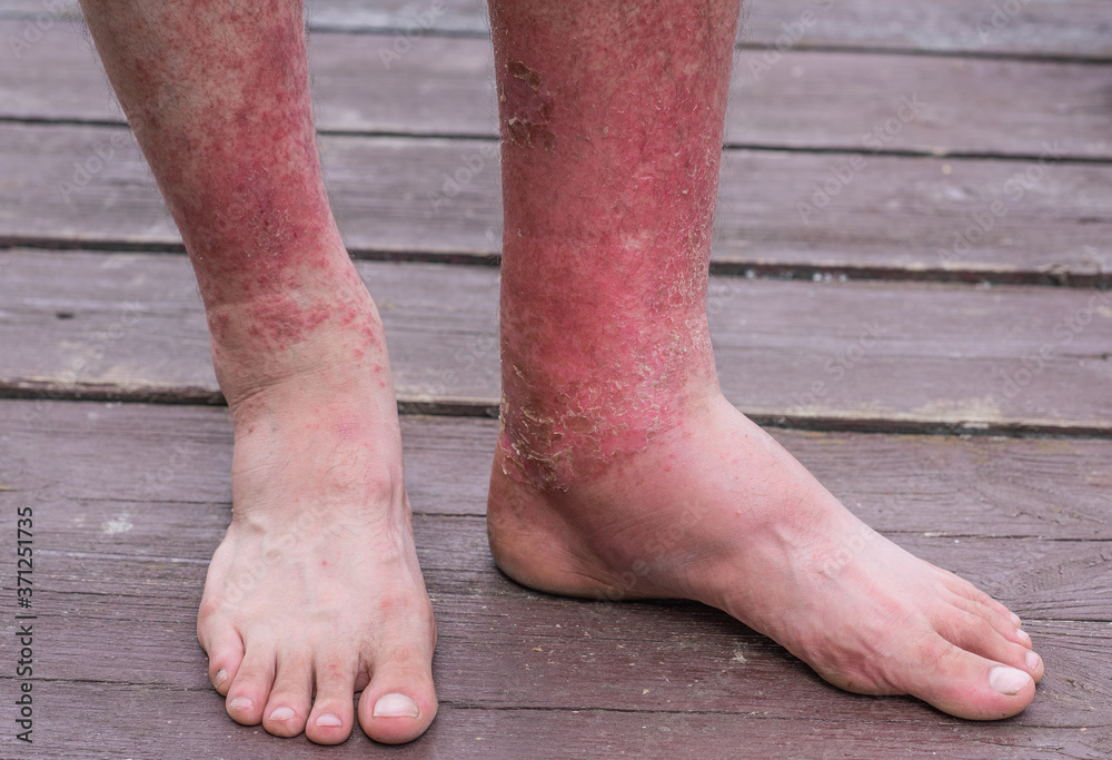 Dyshidrotic autoimmune eczema of patient. Concept of health care Stock