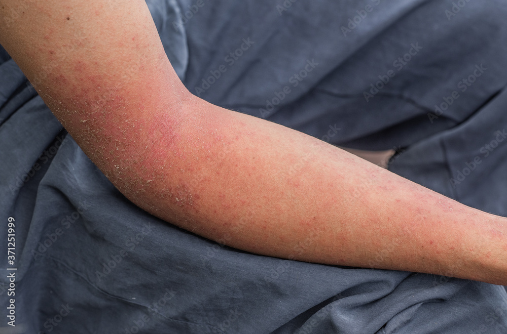 Dyshidrotic autoimmune eczema of patient. Concept of health care Stock Photo Adobe Stock