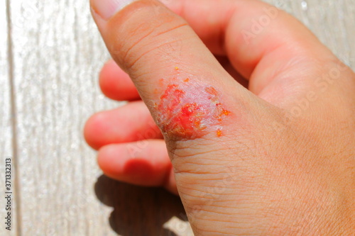 重度のアトピーに苦しむアレルギーを持つ男性の皮膚と指 