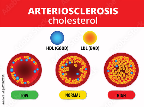 arteriosclerosis , Cholesterol in artery, health risk , vector design photo