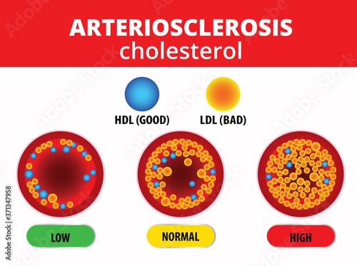 arteriosclerosis , Cholesterol in artery, health risk , vector design