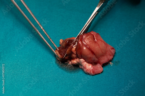 Foto Section specimen of abnormal vascular lesion in the brain after surgical removal