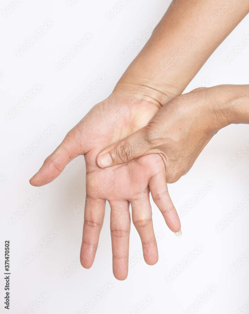 The affected person's hand has arthritic muscle problems. The affected person's hand has arthritic muscle problems.
