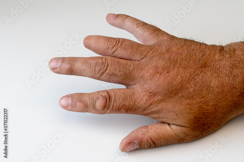 Mans right hand with finger tip of third finger amputated