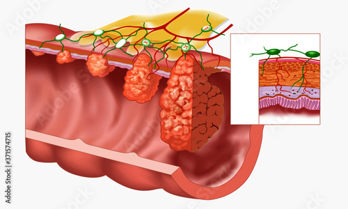 Metastasis to others organs