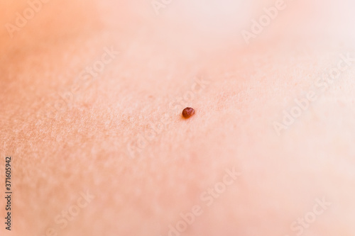 A small wart on a woman's skin.