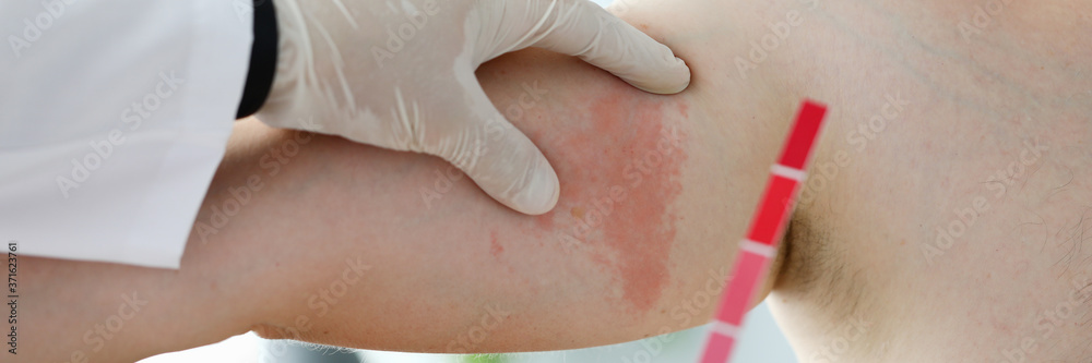 Close-up of doctor dermatologist doing test of body stain. Allergic urticaria on dermal edema Quincke spot with rim. Medicine and laboratory research concept Close-up of doctor dermatologist doing test of body stain. Allergic urticaria on dermal edema Quincke spot with rim. Medicine and laboratory research concept