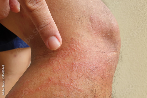 Allergic rash dermatitis eczema skin on patient leg.
