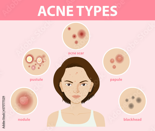 Types of acne on the skin or pimples