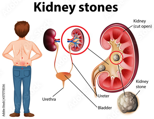 Comparison of healthy kidney and kidney with stones