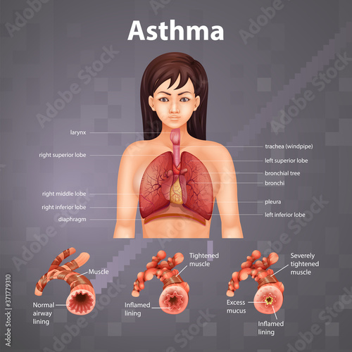 Comparison of healthy lung and Asthmatic lung
