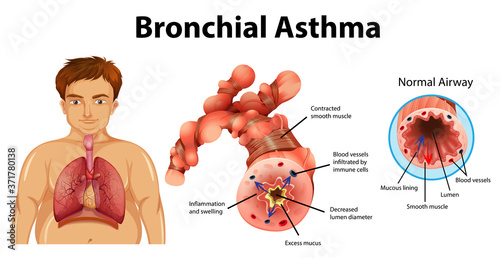 Asthma inflamed bronchial tube