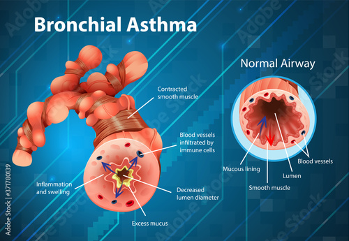 Asthma inflamed bronchial tube