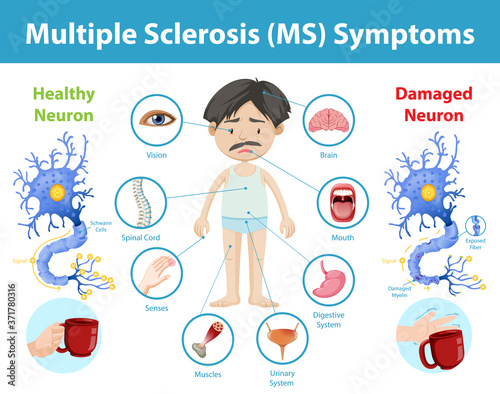 Multiple sclerosis (MS) symptoms information infographic