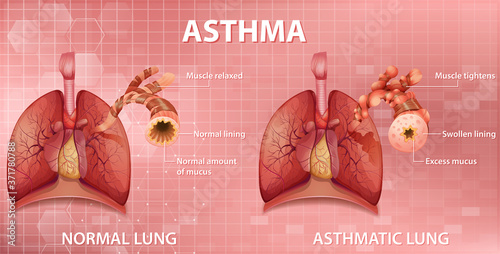 Comparison of healthy lung and Asthmatic lung