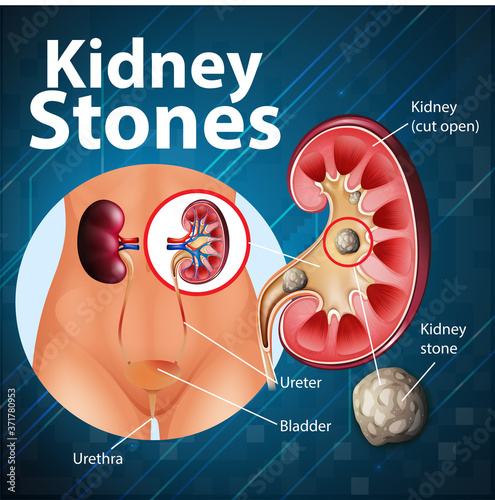 Informative illustration of kidney stones