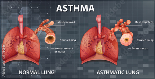 Comparison of healthy lung and Asthmatic lung