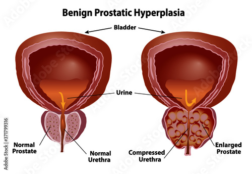 Prostate normal and enlarged. Benign prostatic hyperplasia with compressed urethra. Realistic style isolated on white background. photo